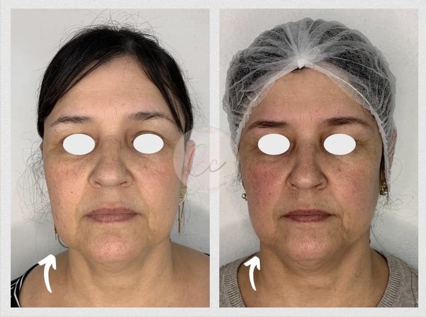 Antes e depois — Rejuvenescimento facial