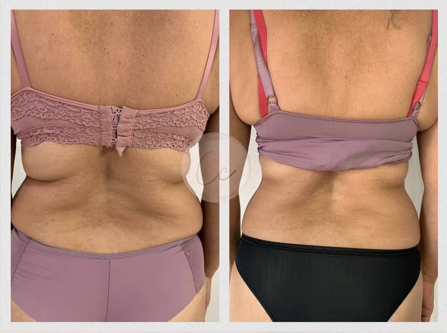 Antes e depois — Gordura localizada nos flancos