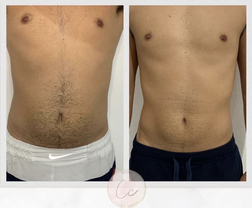 Antes e depois — Definição corporal